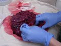 Collection of placental biopsy tissue Tororo malaria project