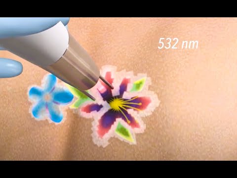 how to treat tattoo