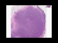 Histopathology Colon--Burkitt lymphoma