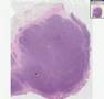 Histopathology Colon--Burkitt lymphoma