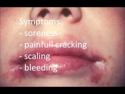 how to cure angular cheilitis