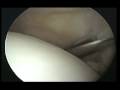 Knee Arthroscopy