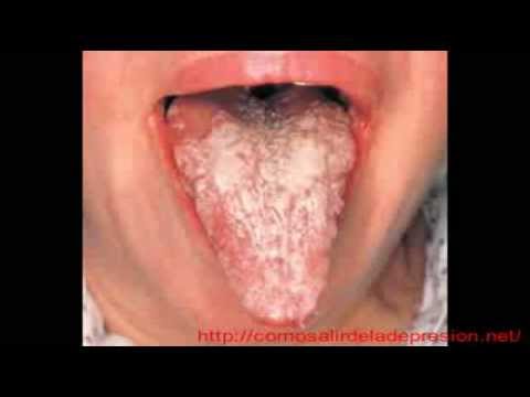 Candidiasis Tratamiento