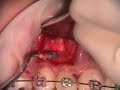 Radicular Lesion Removal and Grafting