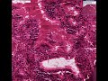 Histopathology Thyroid--Graves disease2