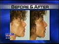 cheek-lift-with-radiesse.html