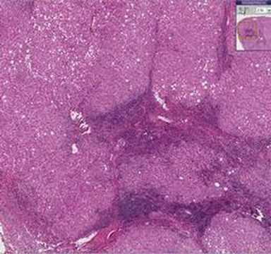 Histopathology Liver--Chronic active ...