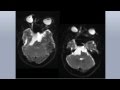 Resection of large epidermoid tumors ventral to the brainstem