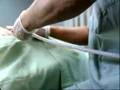 Liposuccion