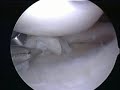 Arthroscopic Meniscectomy (sample)-www.proceduresconsult.com
