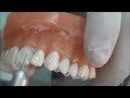 All Ceramic tooth Preparation-demo