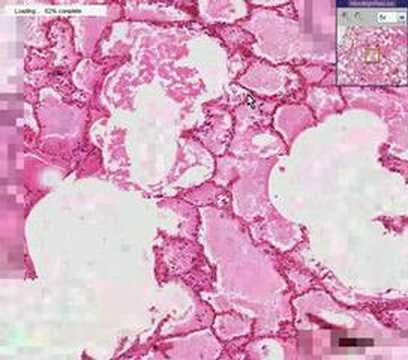 Histopathology Lung --Acute ...