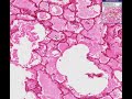 Histopathology Lung --Acute pulmonary edema, Asbestos bodies