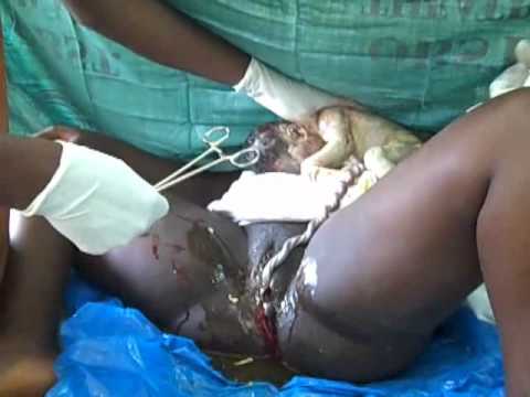 Episiotomy Repair: Episiotomy and delivery of the baby