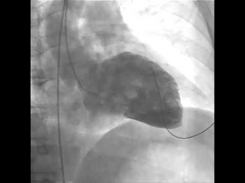 how to treat lv dysfunction