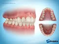 Posterior Crossbite