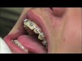 Transition from 012N to 18x25NHA Part 1