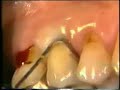 sondaje periodontal