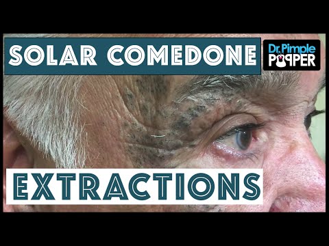 Extensive Solar Comedone Extractions, Part 1: Nickname "Masked Man"