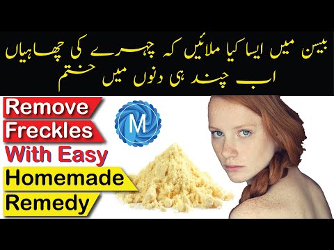 video-linktoworks-How To Get Rid Of Freckles With Easy Home Remedy ||...