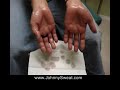 Crazy Excessive Sweaty Palms (Palmar Hyperhidrosis)