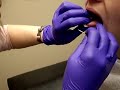 Venom procedure