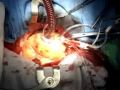 CABG on pump