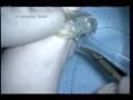 Ahmed Valve, preparation for surgery