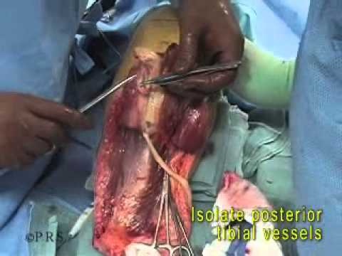 Amputation - 