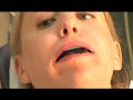 Simplified Dental Impressions using the 5th. hand and Damit