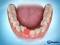 Single Lower Incisor Extraction