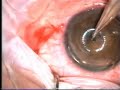 Corneal Graft
