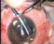 Corneal Graft