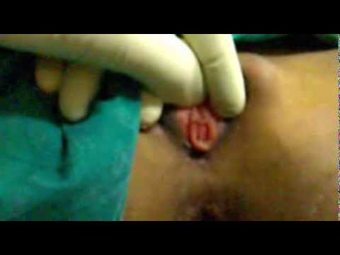 how to cure vulvar vestibulitis syndrome