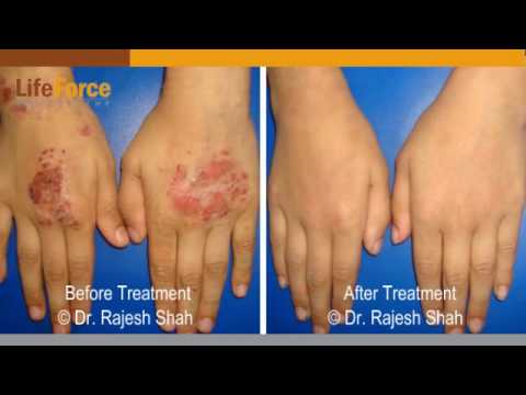 how to treat atopic dermatitis