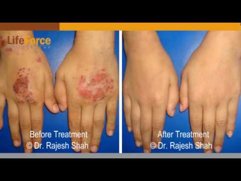 how to cure atopic dermatitis