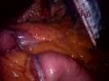 Laparoscopic gastric bypass with subtotal gastrectomy