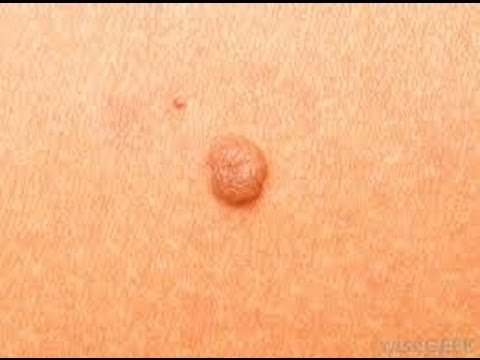 how to remove skin t