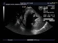 Transesophageal Echocardiography LVH Transesophageal Echocardiography LVH