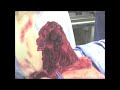 Osteosarcoma Proximal Humerus Part 3 of 6 Osteosarcoma Proximal Humerus Part 3 of 6