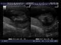 Ecografia del Antonio Nu�ez - Nuestro bebe