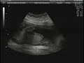Baby P