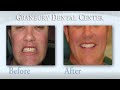 Porcelain Veneers Dallas and Fort Worth, Texas