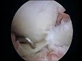 Knee arthroscopy (part V)