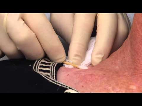 DermaBlade - DermaBlade 