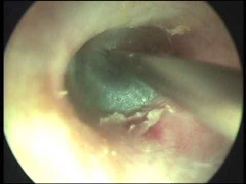 how to drain middle ear fluid