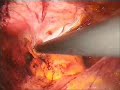 ENDOSCOPIC HERNIA REPAIR (Kapal? F?t?k Ameliyat?) ENDOSCOPIC HERNIA REPAIR (Kapal? F?t?k Ameliyat?)