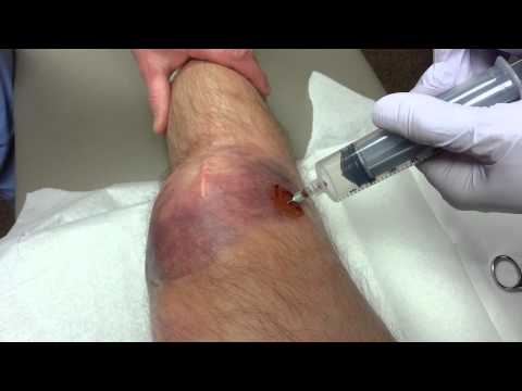 how to drain hematoma