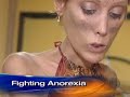 Anorexia\