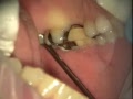 Periodontal Endoscopy and Microsurgery: Implant Repair